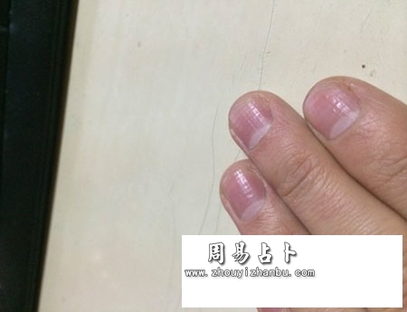 指甲横纹