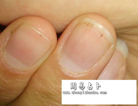 指甲黑斑点