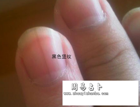 指甲黑色竖纹